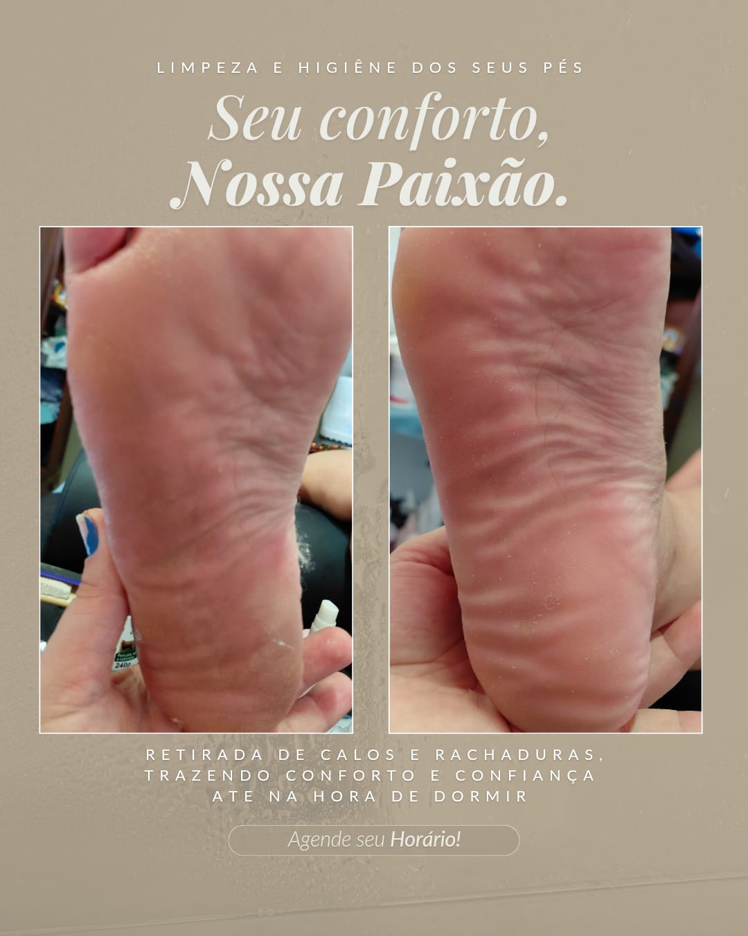 Pedicure + Remoção Calos